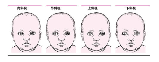 蘭州眼科專家:孩子斜弱視早發(fā)現(xiàn)早