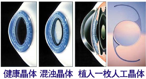 超聲乳化手術白內(nèi)障危險嗎？