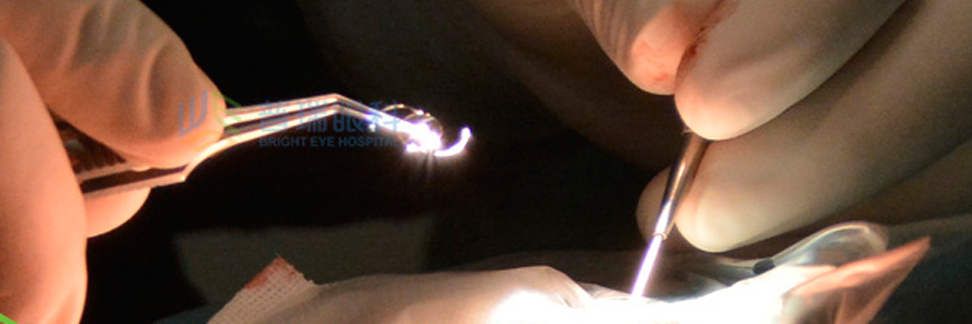 老人看不清，霧蒙蒙，視力逐漸下降這有可能是白內障眼病