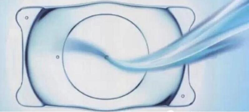 為什么ICL晶體近視眼手術(shù)時(shí)間會(huì)很長？