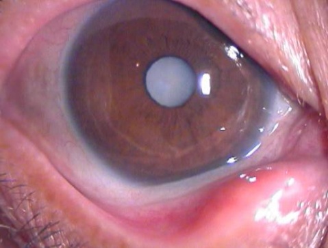 眼科醫(yī)生教你:如何預防白內(nèi)障?