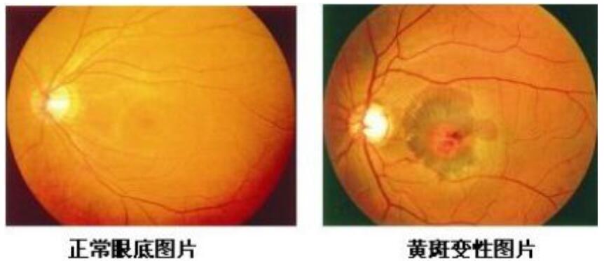 知道嗎？熬夜多了，你的眼睛也就“黃了”  很多年輕人為了