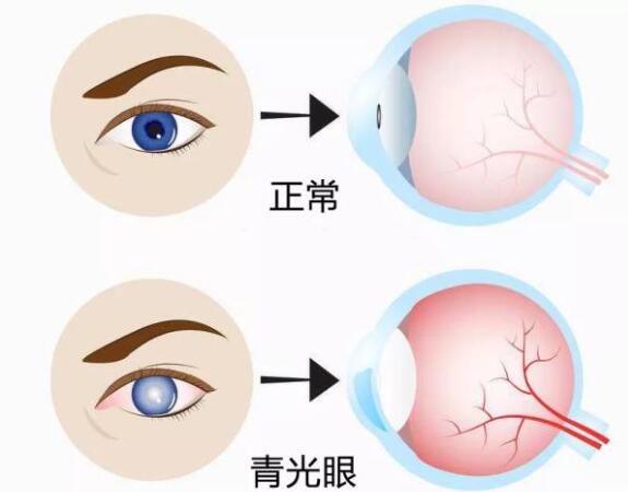 第17個(gè)青光眼周｜共管慢病青光眼，留得光明恒久遠(yuǎn)